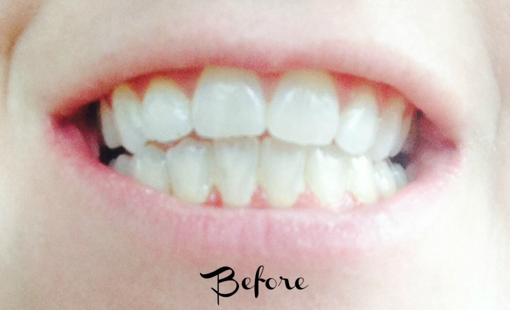 teeth1
