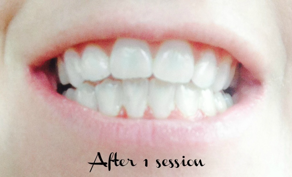 teeth2